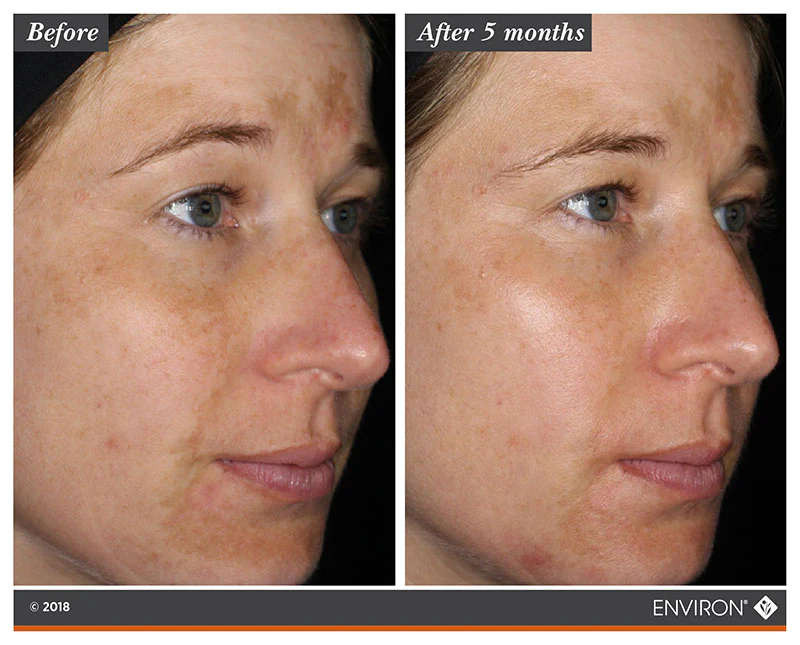 Environ Intense C-Boost Mela-Even Cream results Environ Intense C-Boost Mela-Even Cream results