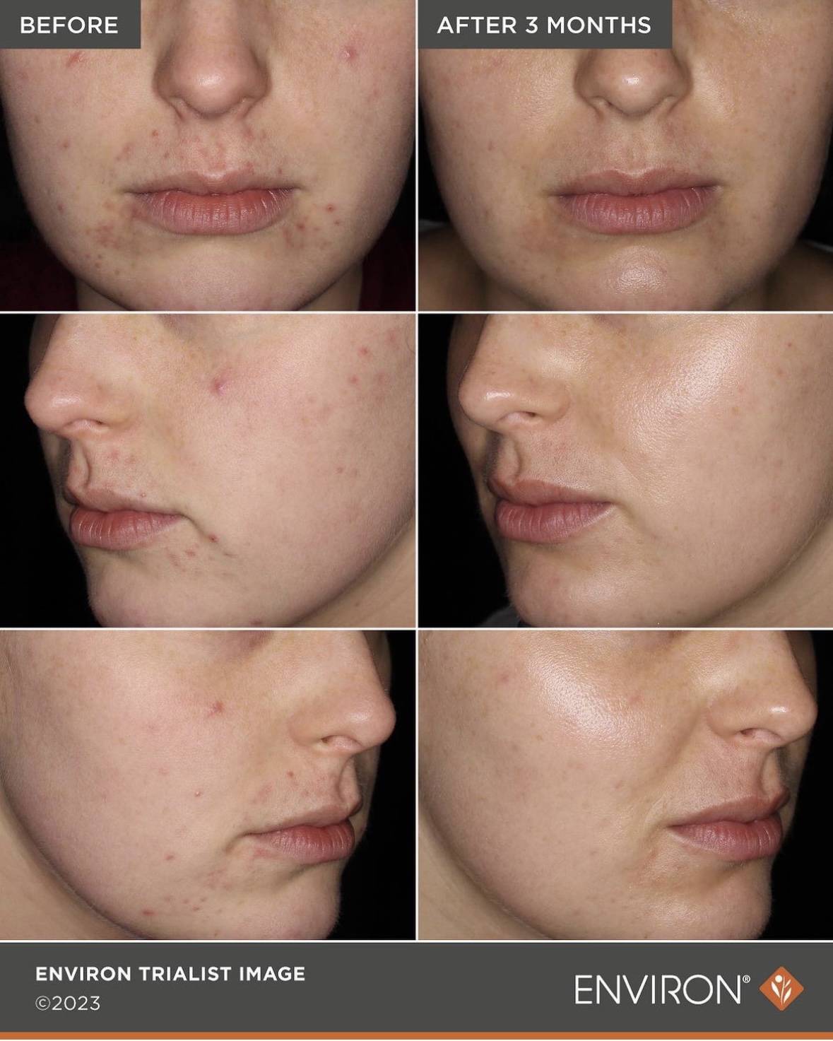Environ Sebu-Clear results Environ Sebu-Clear results